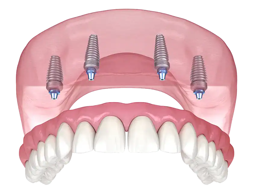 All-on-4 Implants