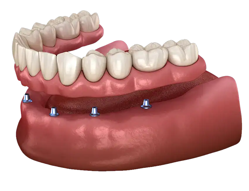 Implant Supported Dentures