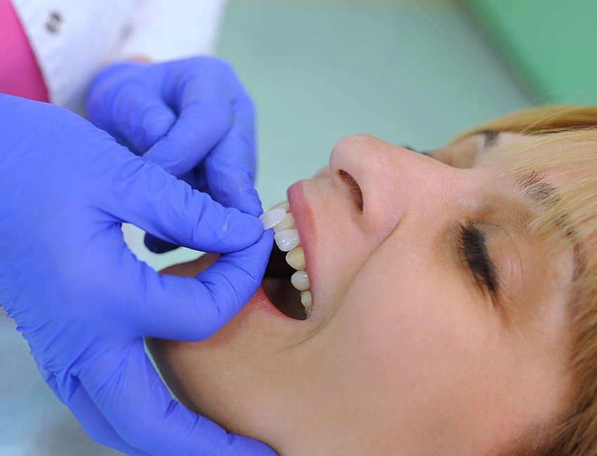 What is Dental Veneers and Laminates