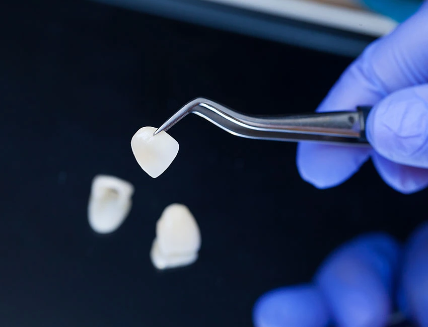 Dental Veneers and Laminates at Gardena Dental Group