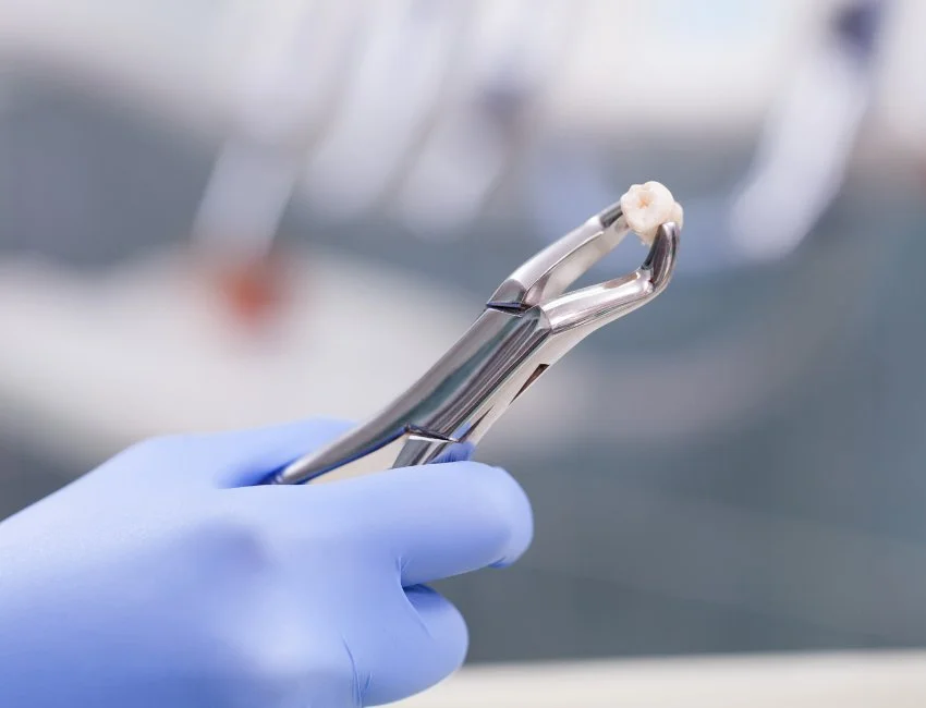 Tooth Extraction in Gardena, CA