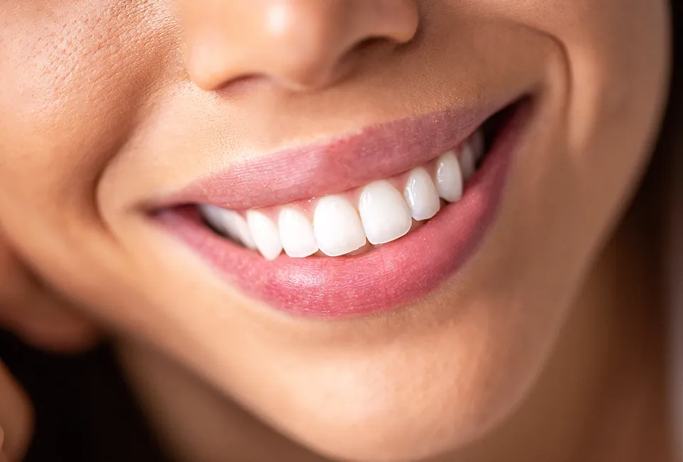 Gardena veneers patient