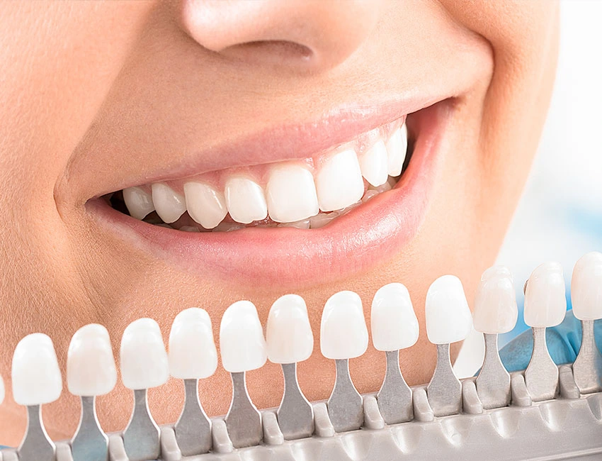 What is Teeth Whitening