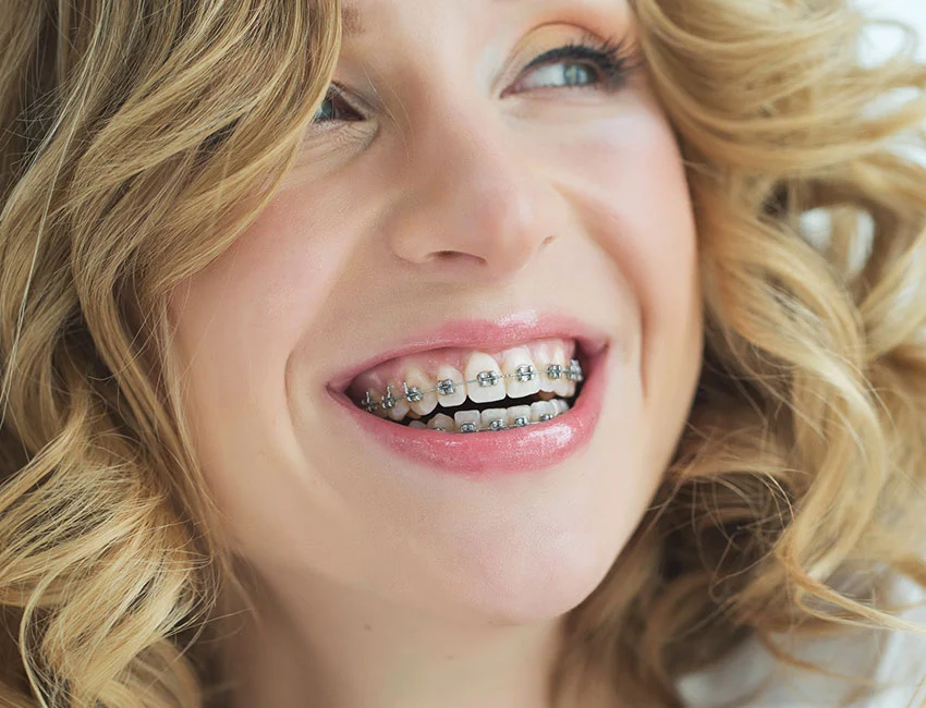 What is Orthodontic Braces