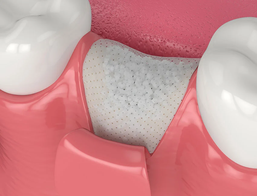 Bone Graft