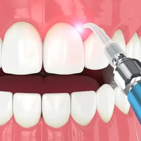 Laser Dentistry