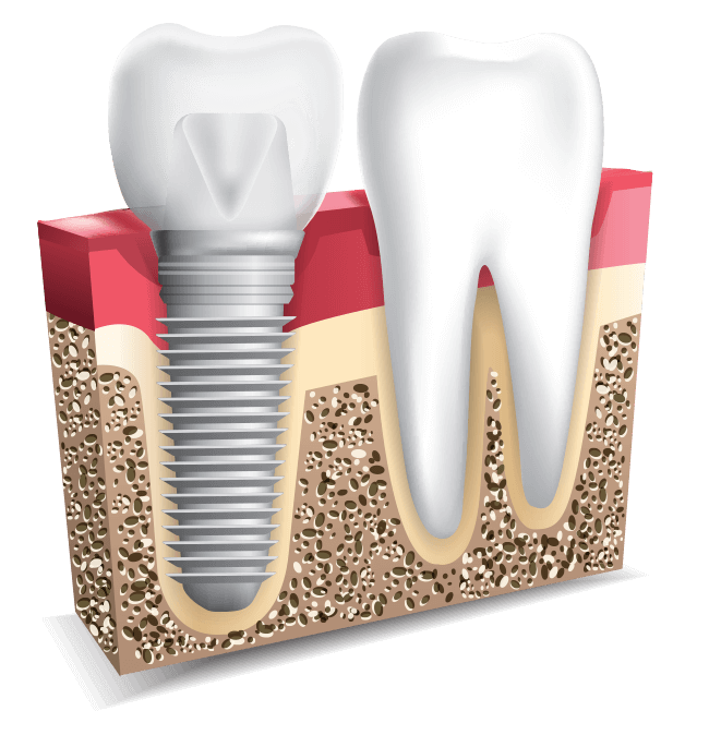 Dental Implants 3D Model